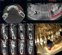 歯科用CTスキャンとインプラント