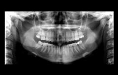 歯科用ＣＴスキャンと歯周病治療